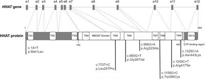 Novel variant in HHAT as a cause of different sex development with partial gonadal dysgenesis associated with microcephaly, eye defects, and distal phalangeal hypoplasia of both thumbs: Case report